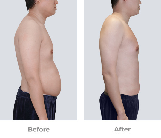 Mens Expressions Singapore Success Story Hanrey BodyKa, Crystal Freeze and X-Wave Shockwave before and after