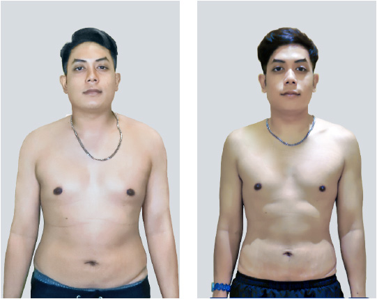 Mens Expressions Singapore Success Story Dew Bodyka treatment Before and After