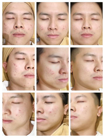 Face Progression Jia Ching Acne Skin Treatment Success Story By Men's Expressions