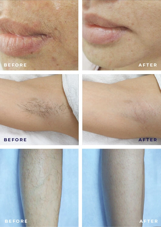 Luminn Hair Removal Men Before After