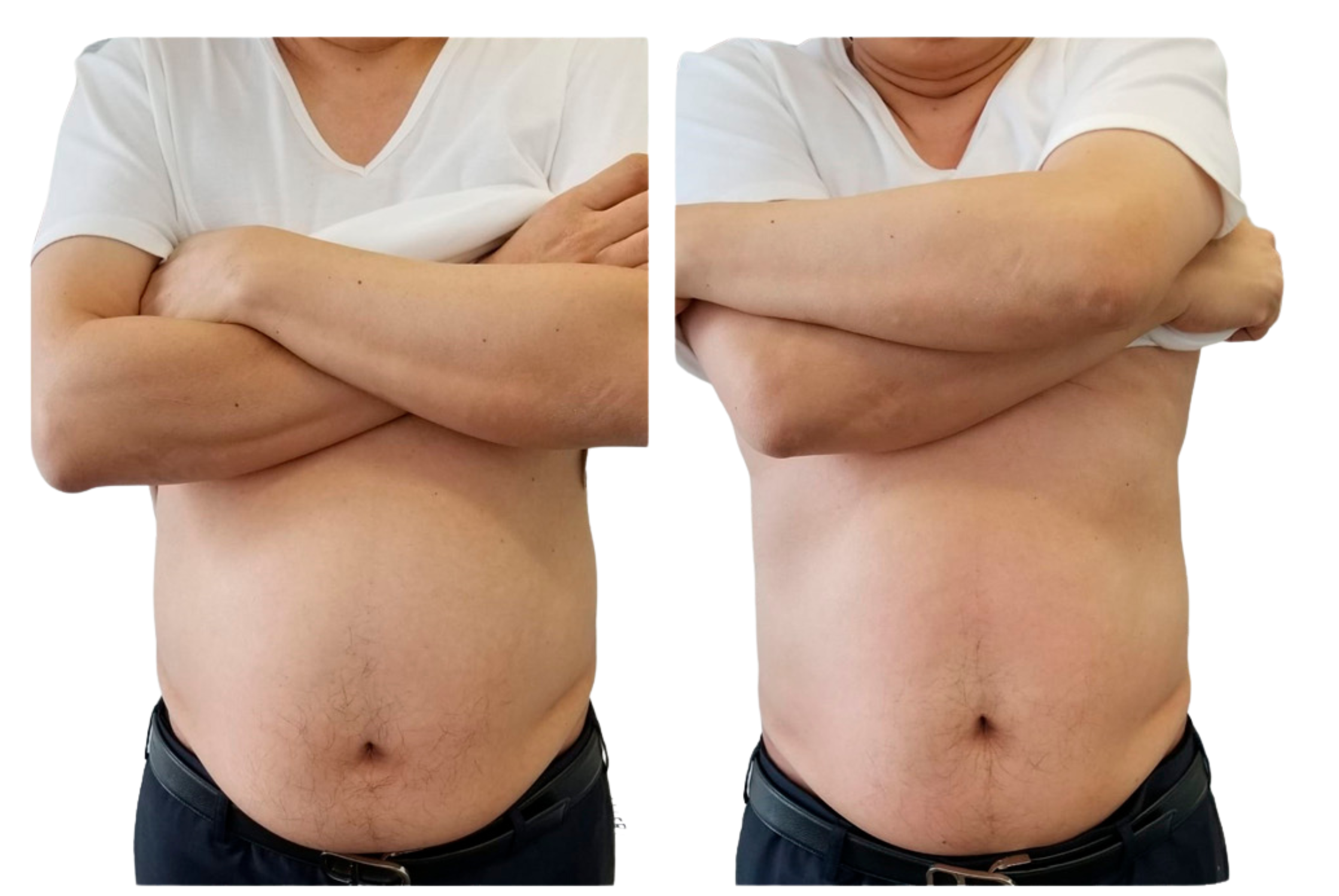 before and after slimming thermowave fat reduction