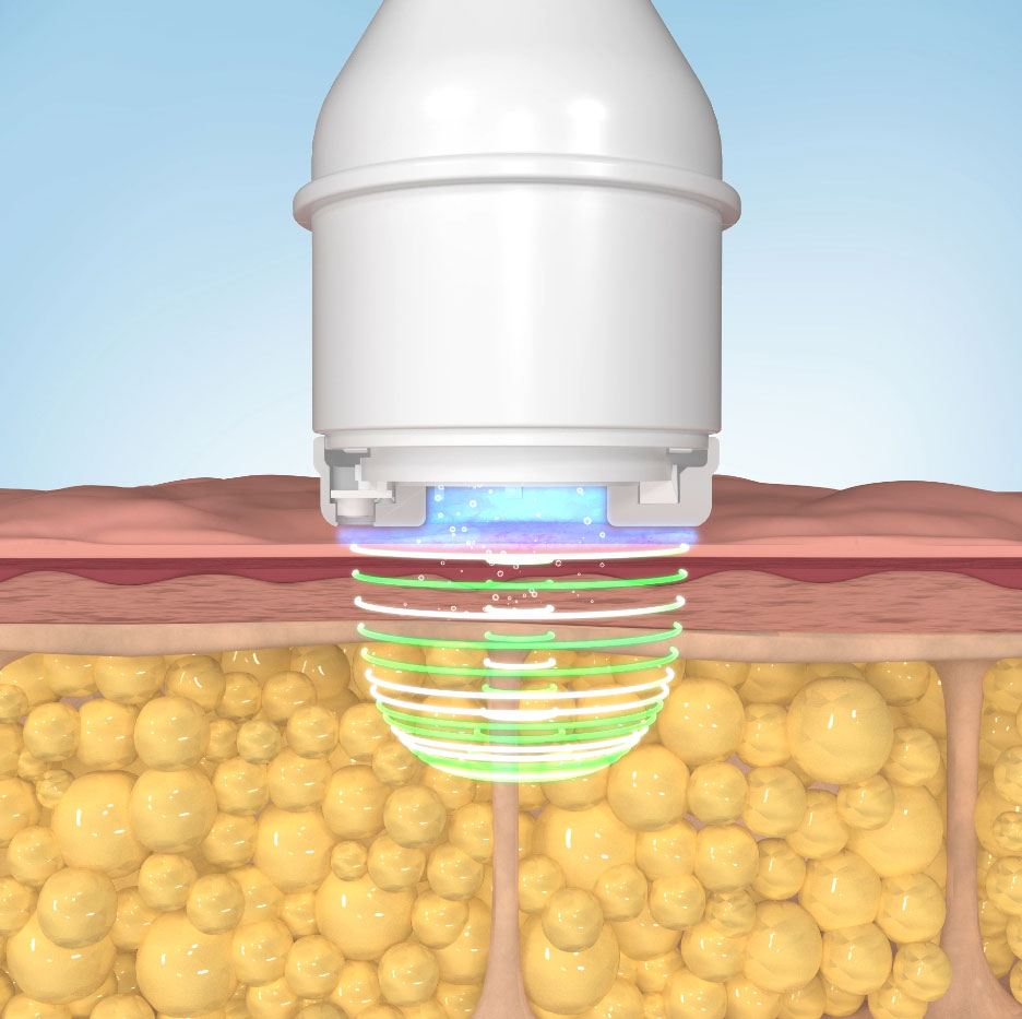 thermo wave handpiece microwave